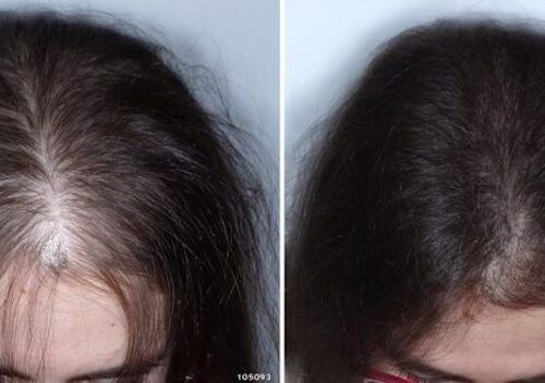 antes-y-despues-alopecia-con-tratamiento-estromalterapia-750x330