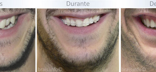 Trés imágenes del tratamiento de un paciente con apiñamiento dental o dientes apiñados, antes, durante y después.