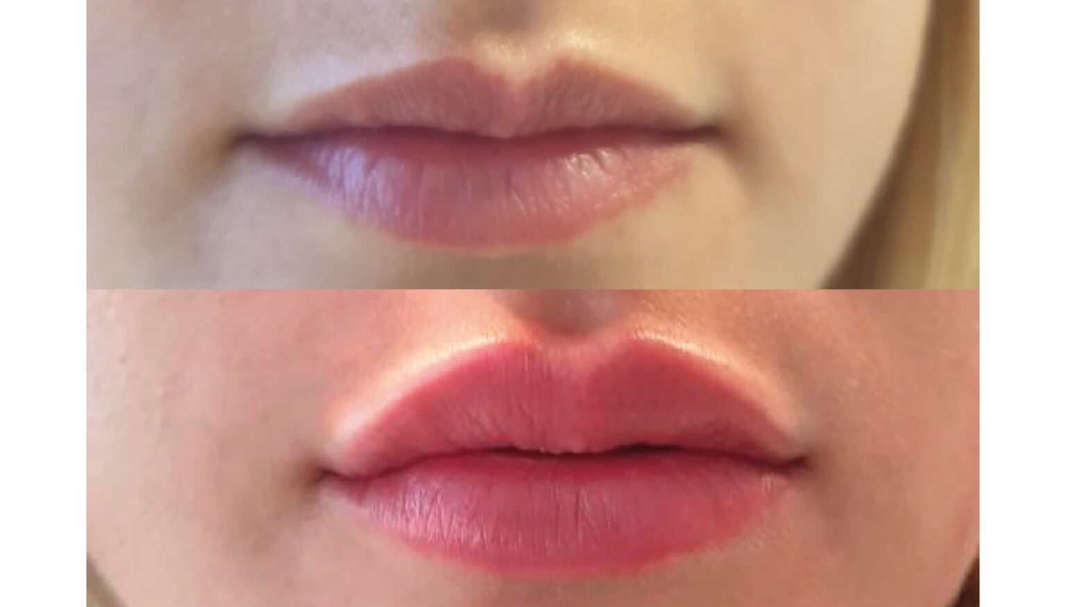 Diseño de Sonrisa + Perfilado y Aumento de Labios – Estética Clinic ...