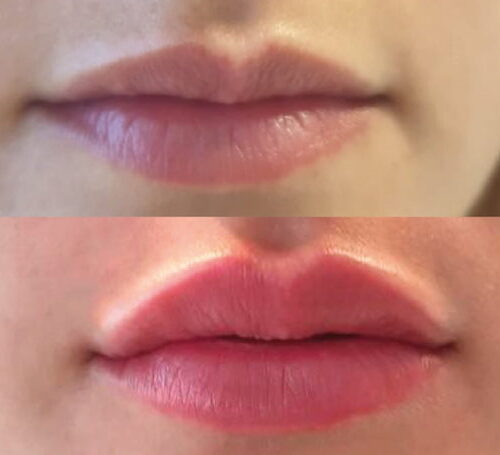 relleno-labios-acido-hialuronico-clinica-estetica-castelblanque-fb